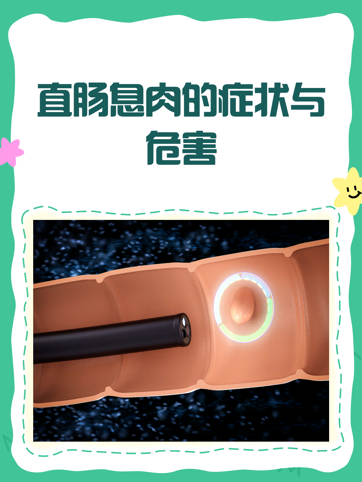 直肠息肉悄无声息？这些症状和危害你得知道！