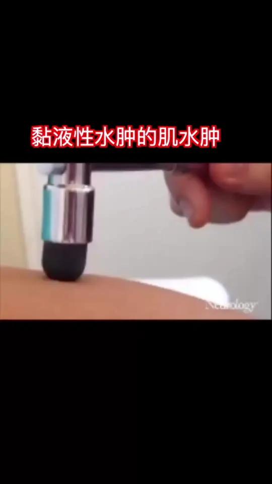 《neurology》杂志的视频,在因为甲状腺功能减退导致的黏液性水肿时,用敲击锤敲击肌肉
