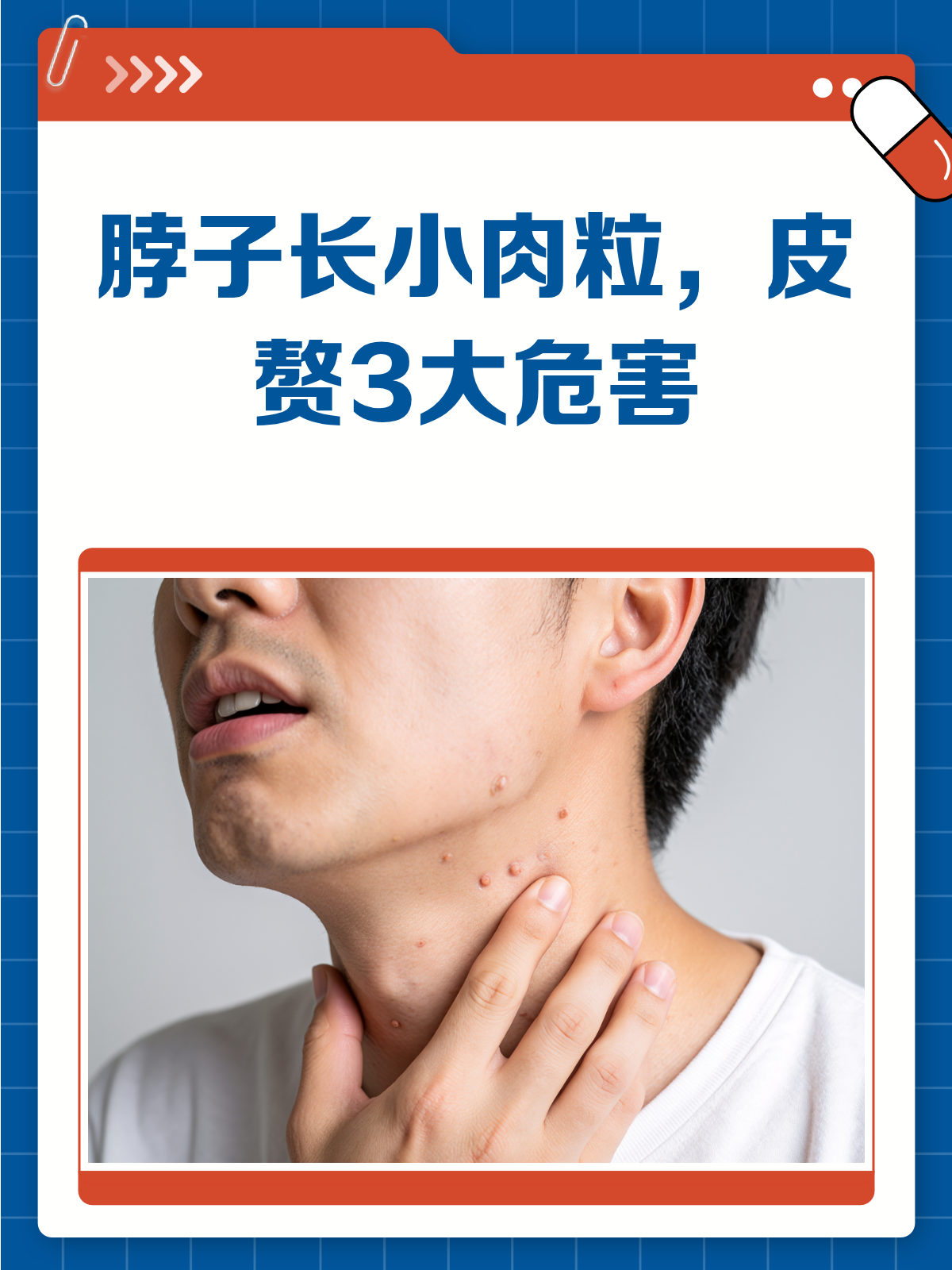 脖子长小肉粒?别忽视,这可能是皮赘!