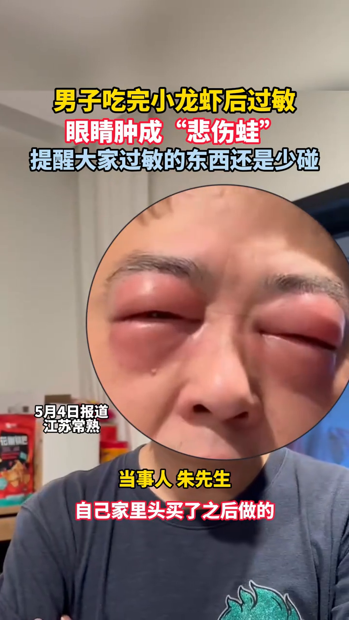 男子吃完小龙虾后过敏眼睛肿成“悲伤蛙”