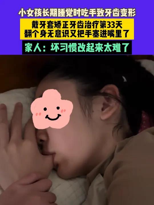 11月3日发布,江苏,小女孩长期睡觉时吃手致牙齿变形,戴牙套矫正牙齿治疗第33天,翻个身无