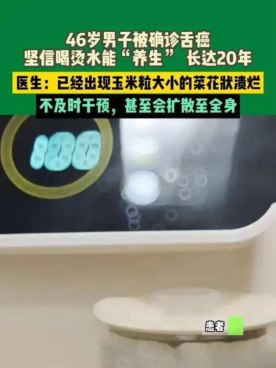 46岁男子被确诊舌癌,坚信喝烫水能“养生” 长达20年,医生:已经出现玉米粒大小的菜花状溃