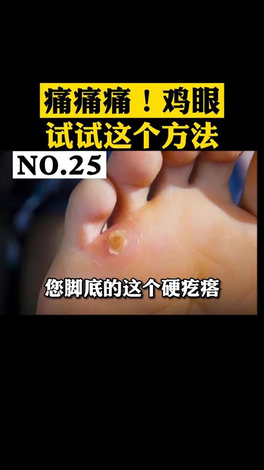 痛痛痛!长了鸡眼怎么办