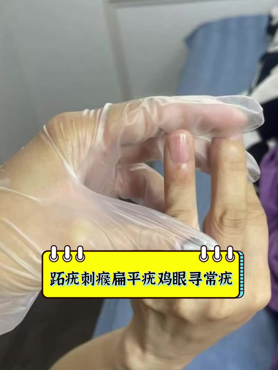 跖疣刺瘊扁平疣鸡眼寻常疣