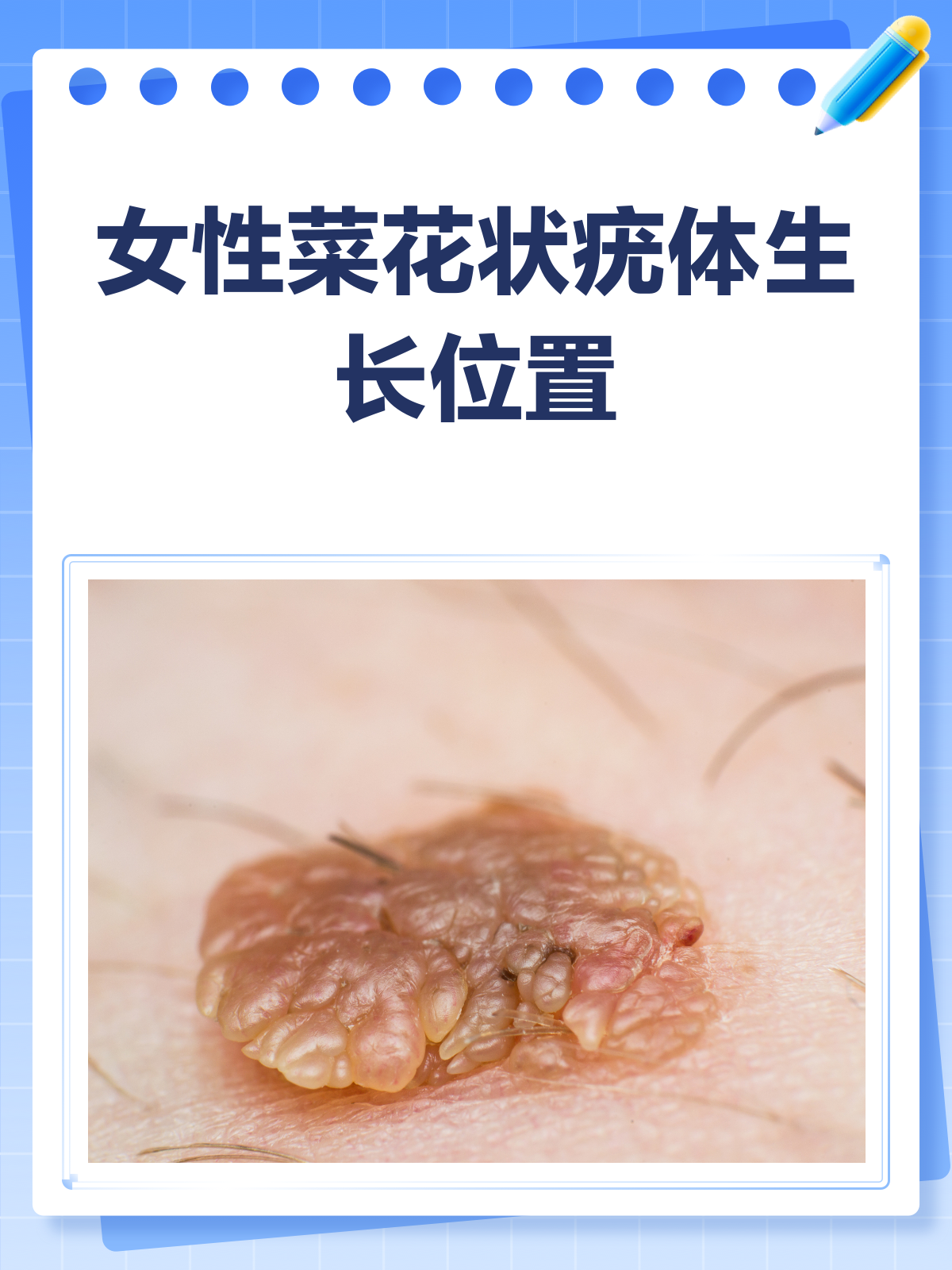女性菜花状疣，这些私密部位要警惕！