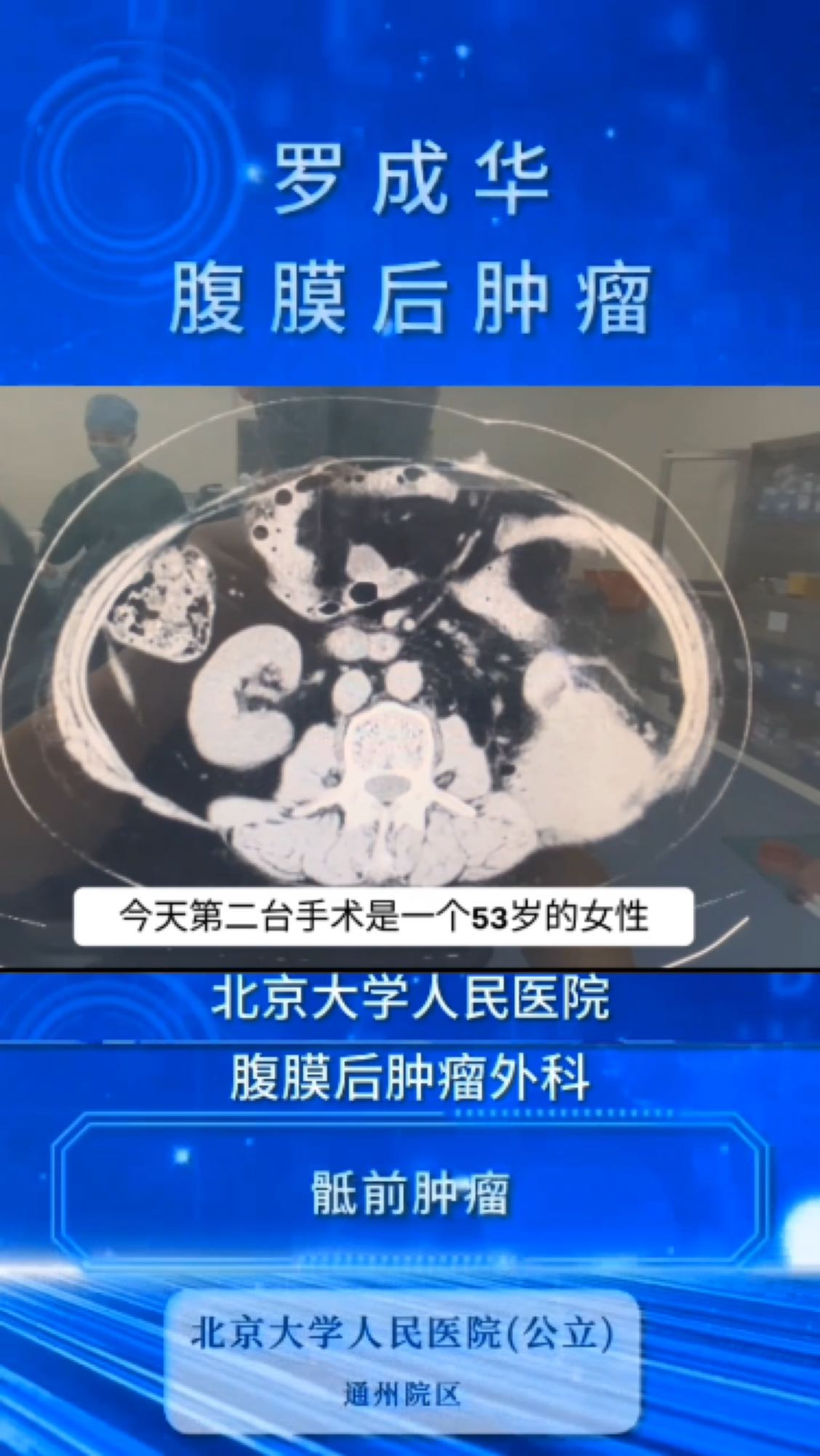 今天手术的腹膜后脂肪肉瘤长到背上了 腹膜后脂肪肉瘤