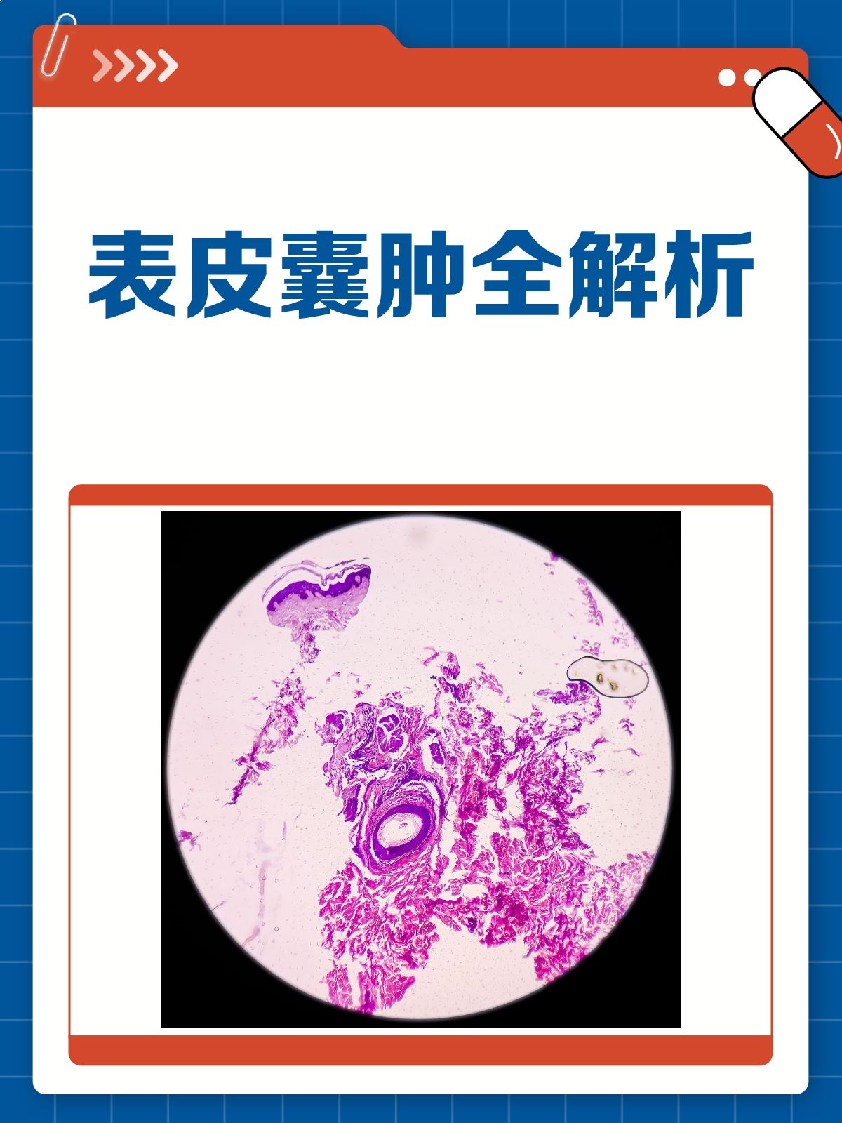 表皮囊肿知多少?原因、症状与治疗全解析!
