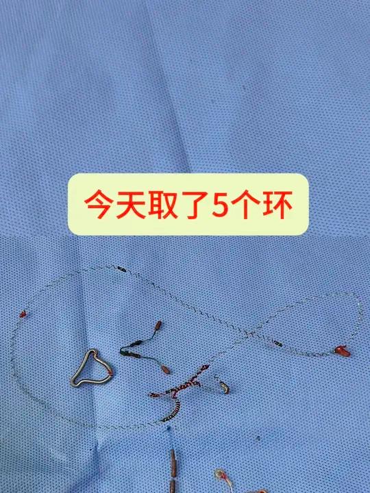 今天取了5个环,建议女性朋友绝经后及时取环