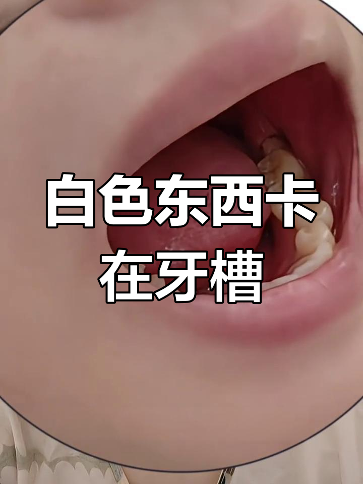 拔智齿后,白色异物让我无法忍受
