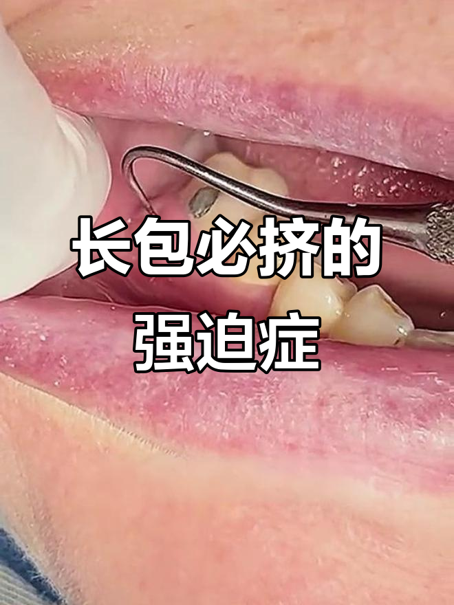 嘴巴里长包,强迫症患者必须亲手消除!