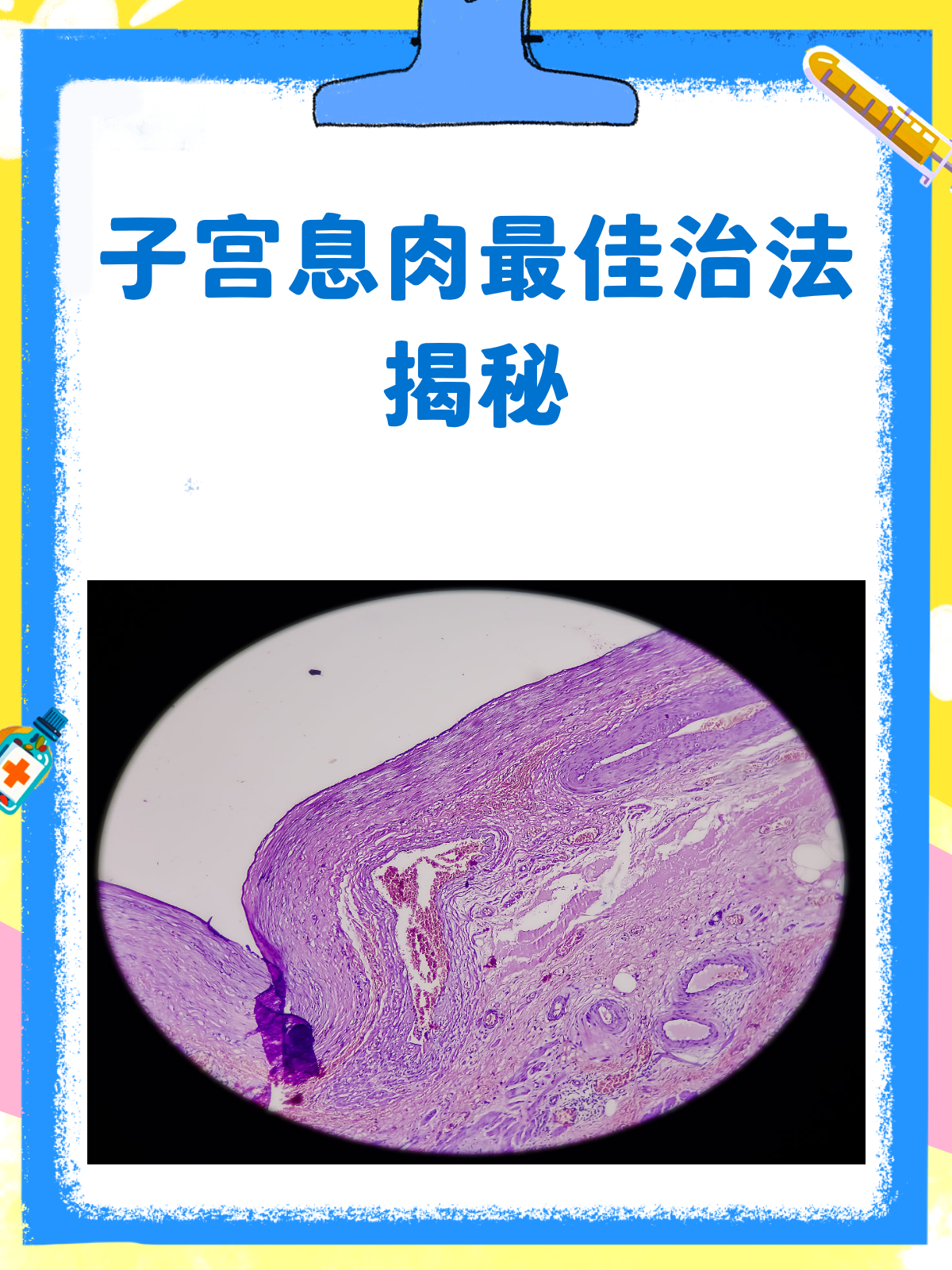 子宫息肉怎么办?最佳治疗方案来啦!