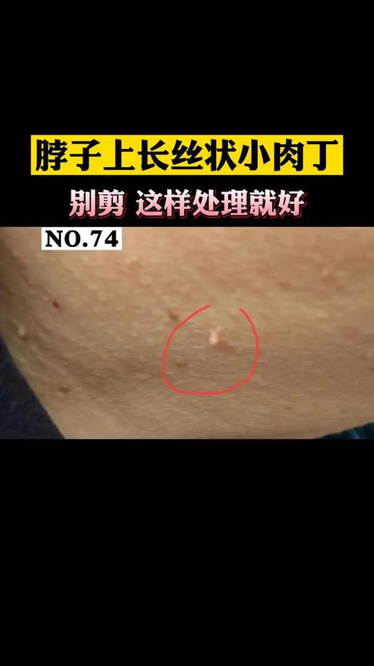脖子、眼睑上长丝状的小揪揪,这是hpv引起的丝状疣,别拔,可以这样简单处理