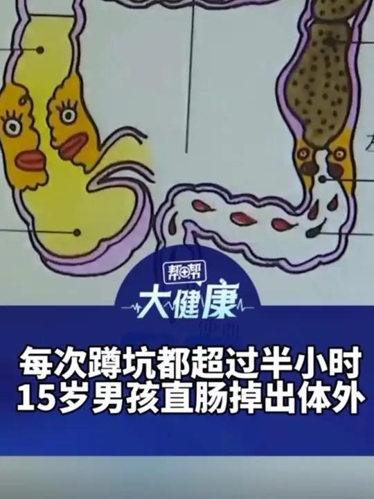 每次蹲坑都超过半小时 15岁男孩直肠掉出体外 医生:5分钟是排便黄金时间 应对急性便秘 每