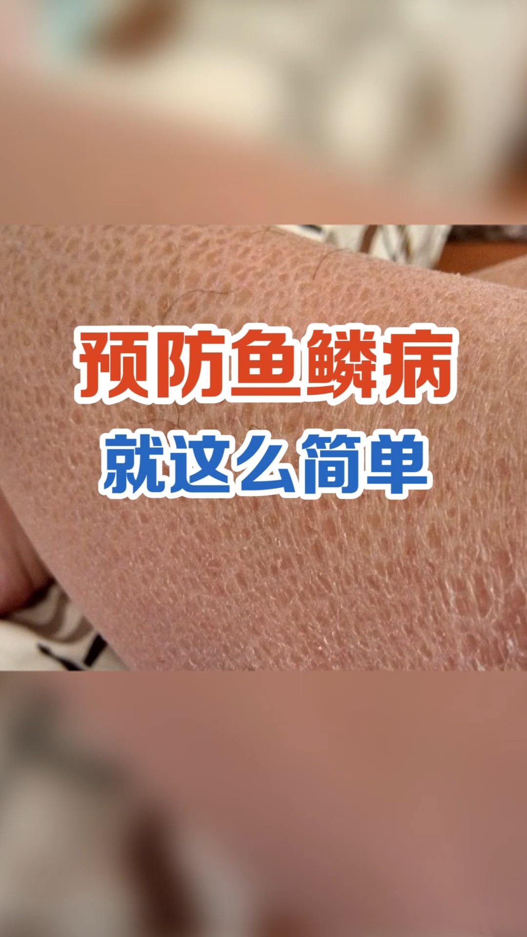 预防鱼鳞病,就这么简单