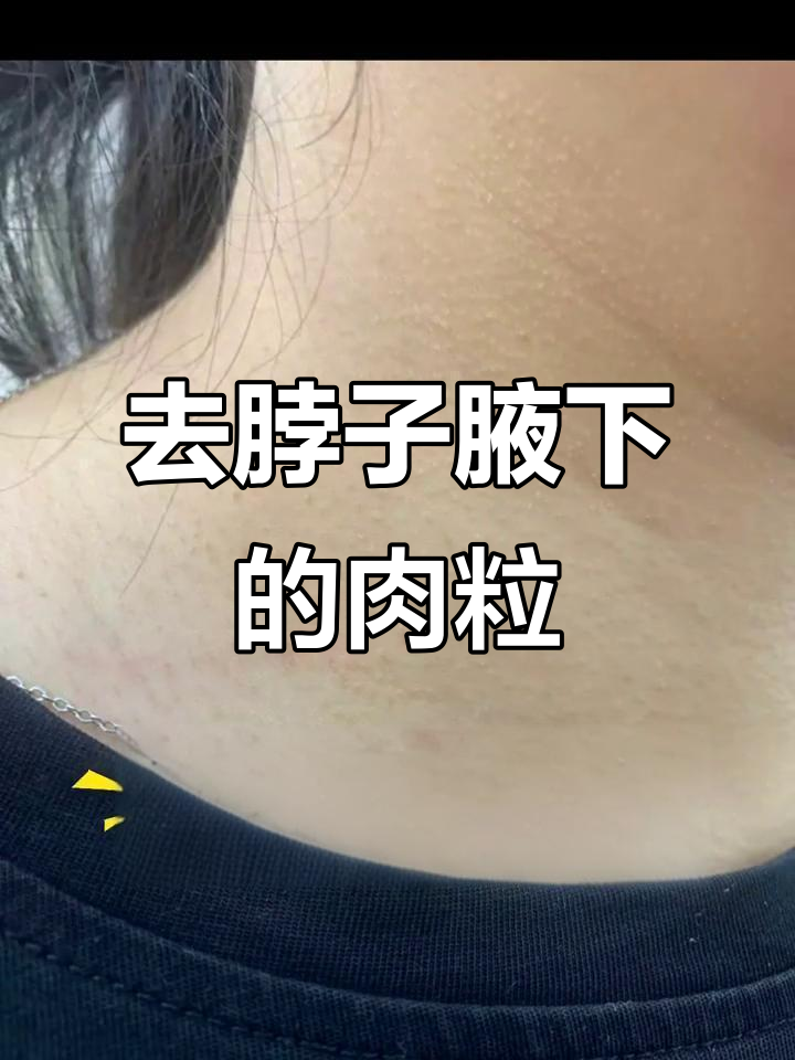 脖子腋下小肉粒多?试试这个方法轻松去除