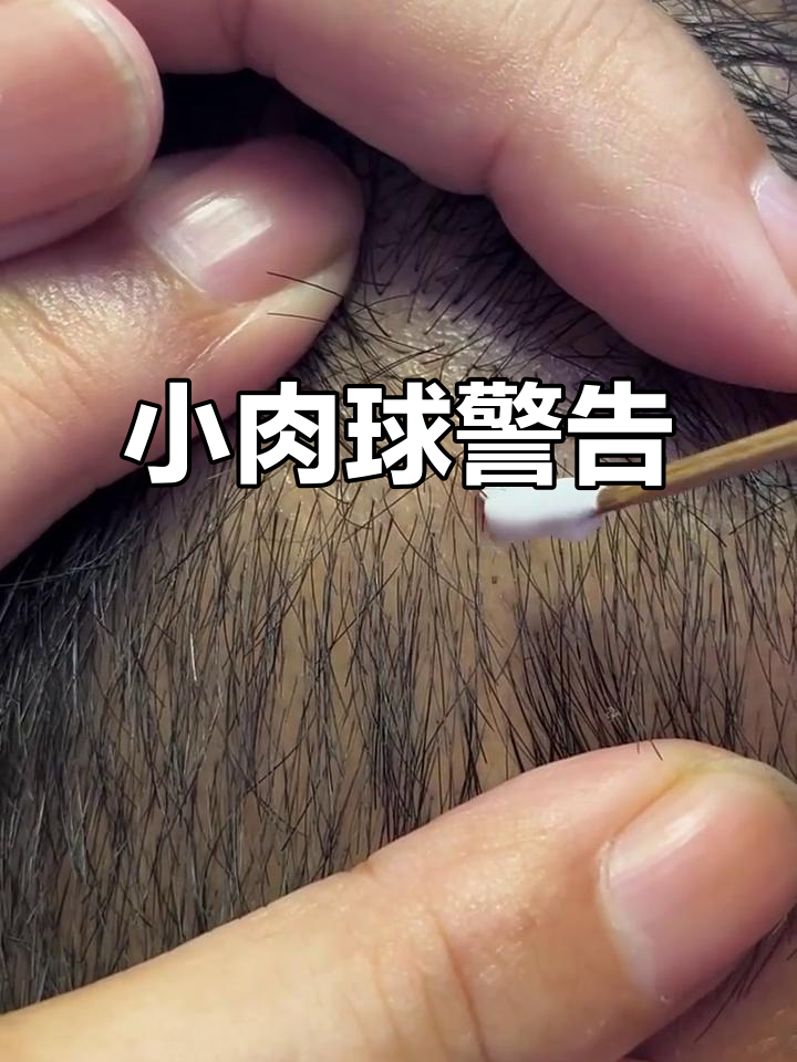 头上长小肉球？警惕这种开花猴子，操作方法揭秘