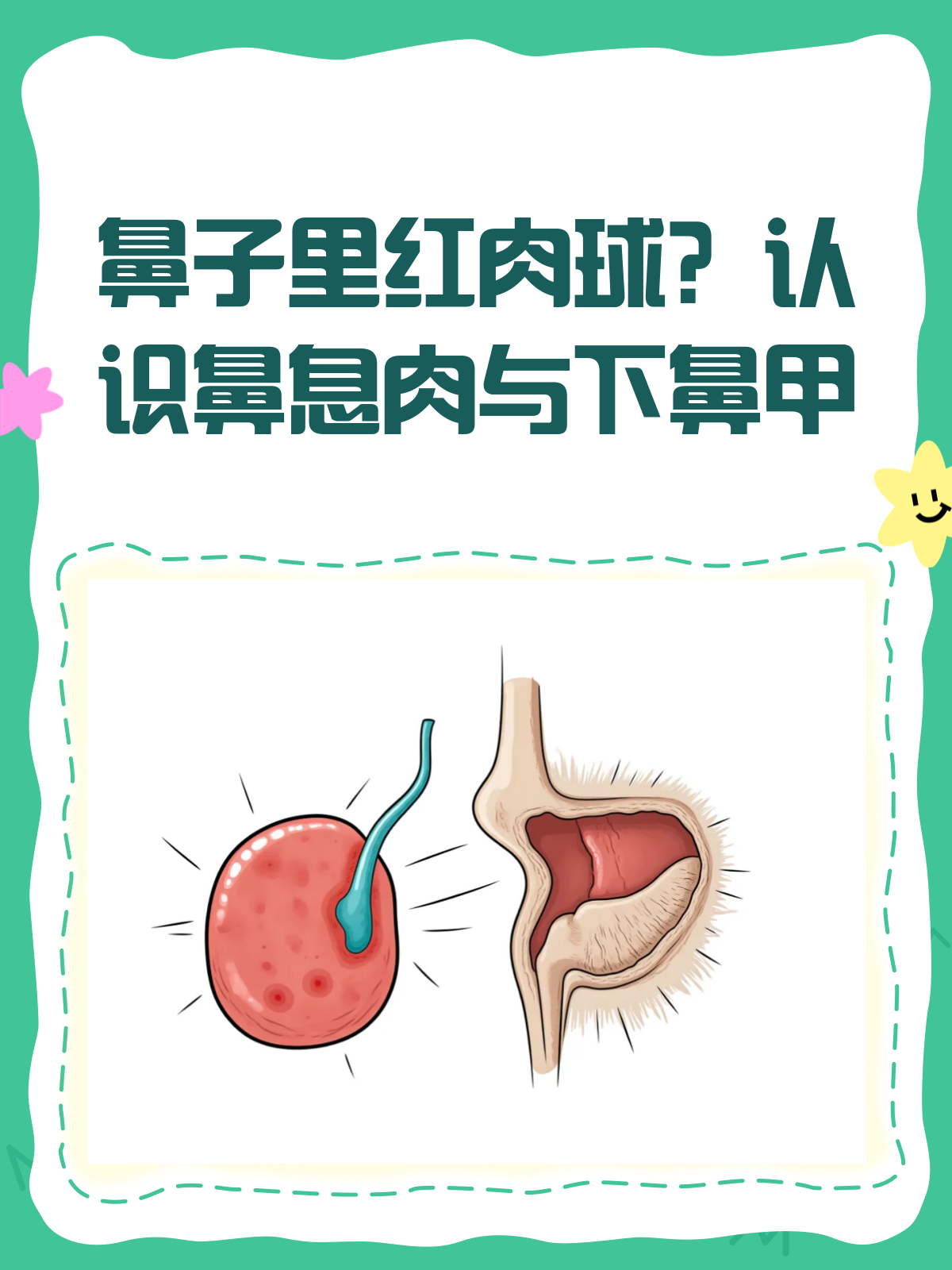 鼻子里红肉球≠鼻息肉,一文教你辨清楚!