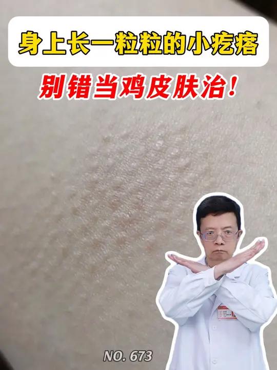 身上长一粒粒的小疙瘩，这不是鸡皮肤，也不是湿疹！