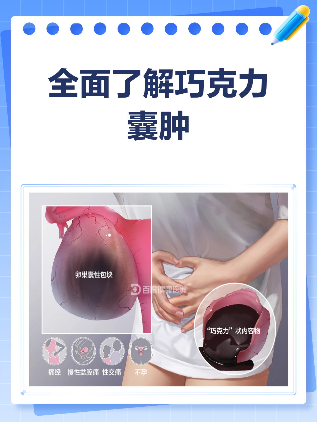 揭秘巧克力囊肿,它到底是什么病?