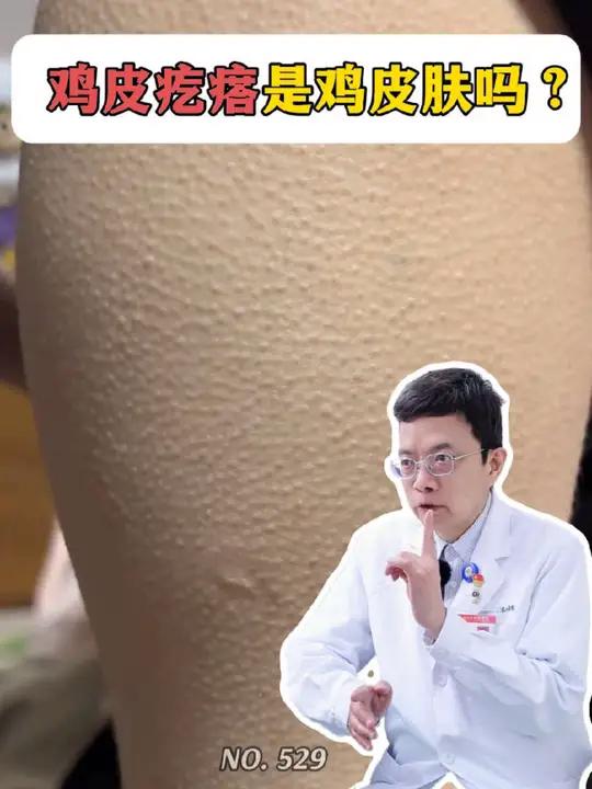 鸡皮肤就是鸡皮疙瘩吗?觉得难看怎么办?医生一招教你处理