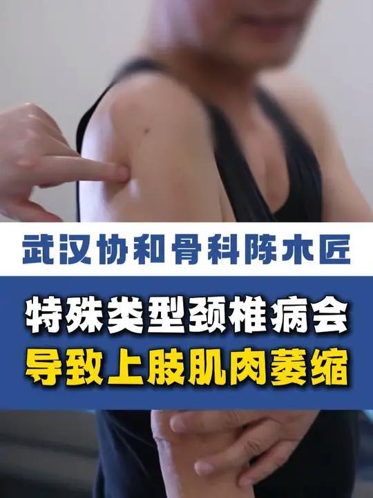 特殊类型颈椎病会导致上肢肌肉萎缩