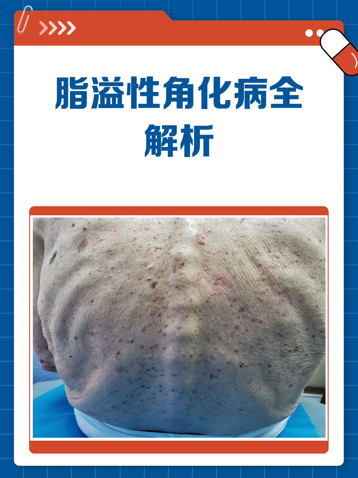 脂溢性角化病大揭秘！皮肤上的小肉瘤是啥？