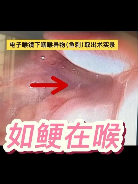 电子喉镜下咽喉异物（鱼刺）取出术实录