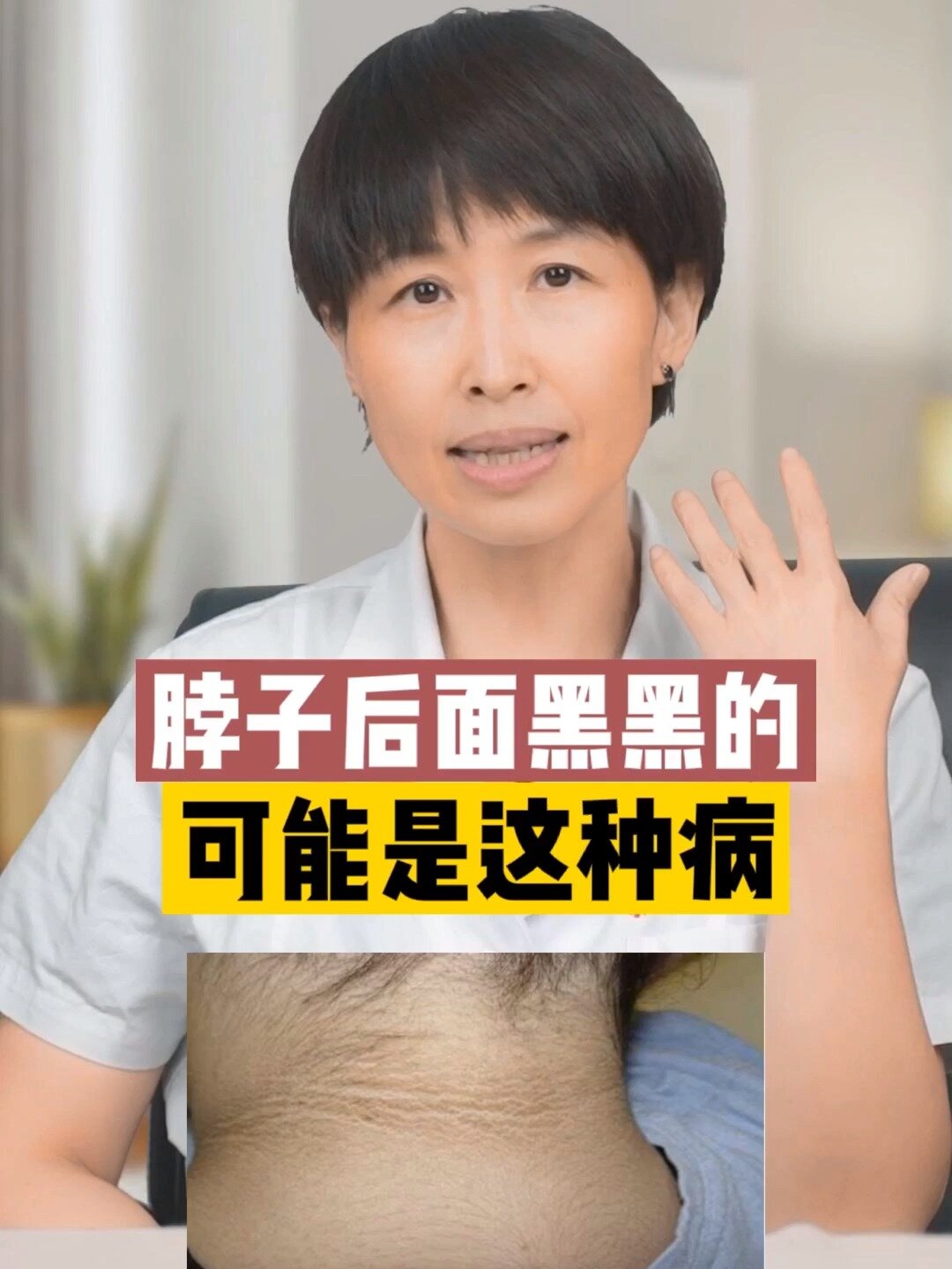 脖子后面黑黑的,可能是这种病