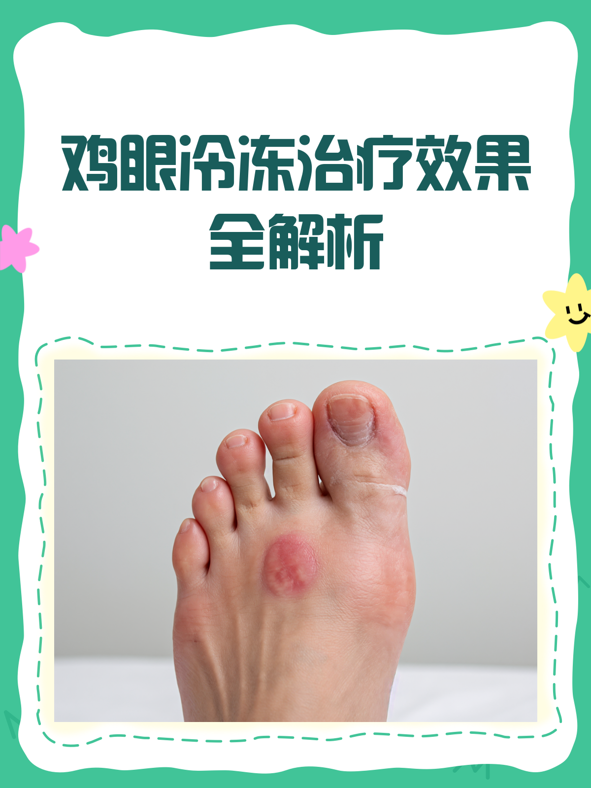 鸡眼冷冻治疗,真的能有效吗?