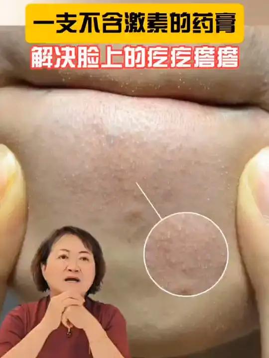 脸上的疙疙瘩瘩是什么怎么办?皮肤科医生一条视频讲清楚!