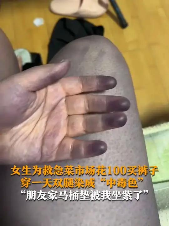 1月12日(采访),吉林长春,女生为救急在菜市场花100元买裤子,穿一天双腿被染成“中毒色