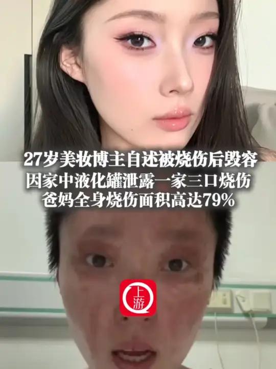 5月27日(报道时间),辽宁沈阳,27岁美妆博主自述被烧伤后毁容 因家中液化罐泄露一家三口