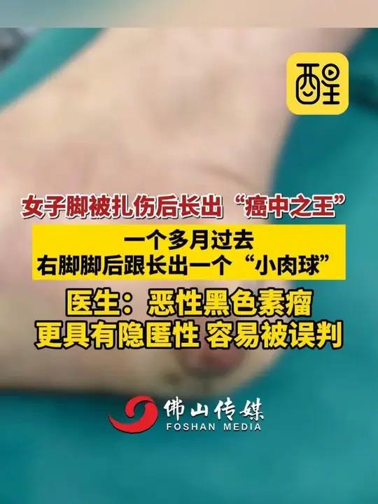 女子脚被扎伤后长出“癌中之王”，一个多月过去，右脚脚后跟长出一个“小肉球”！医生：恶性黑色