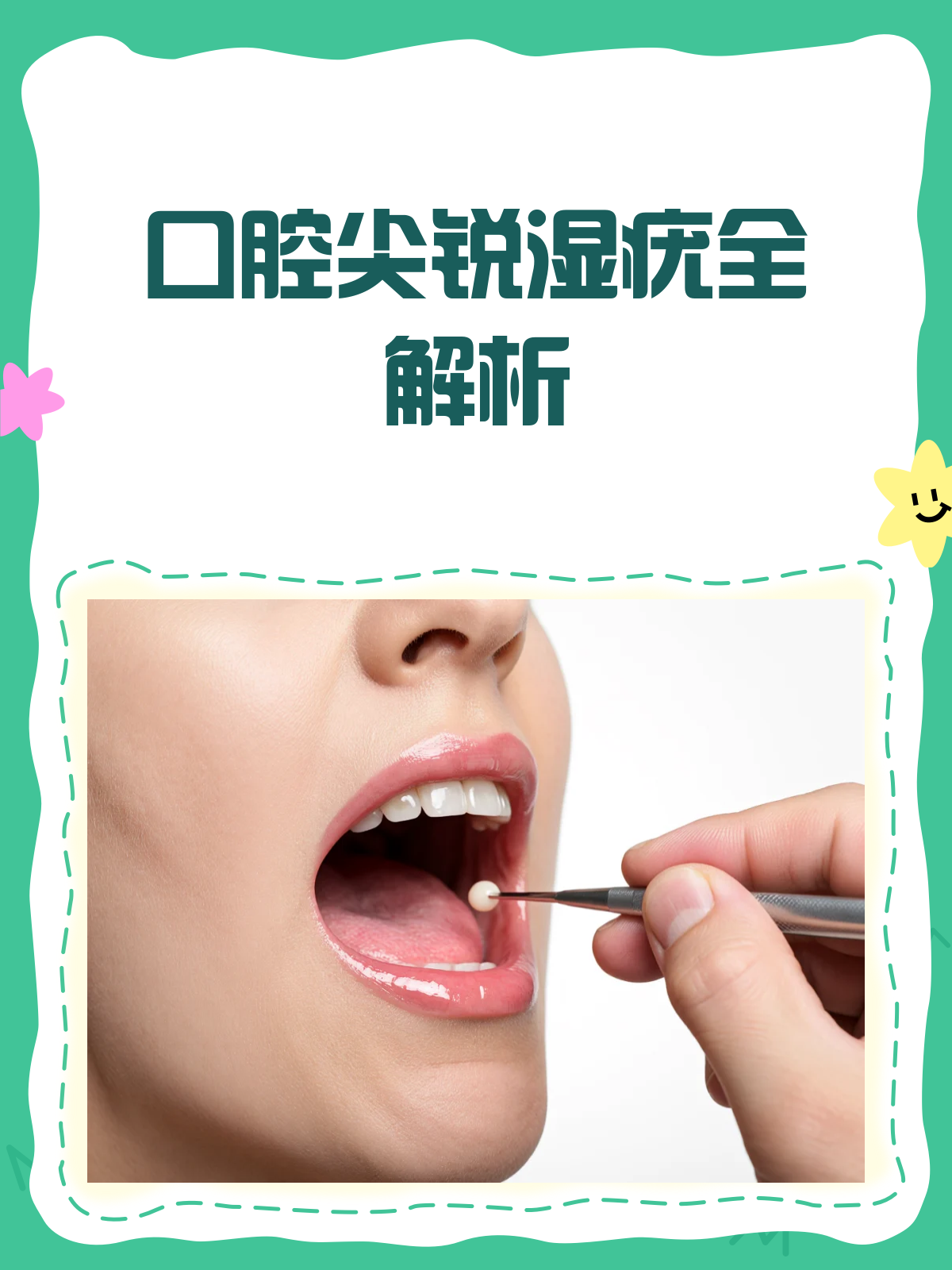 口腔也长“尖尖”?揭秘口腔尖锐湿疣!