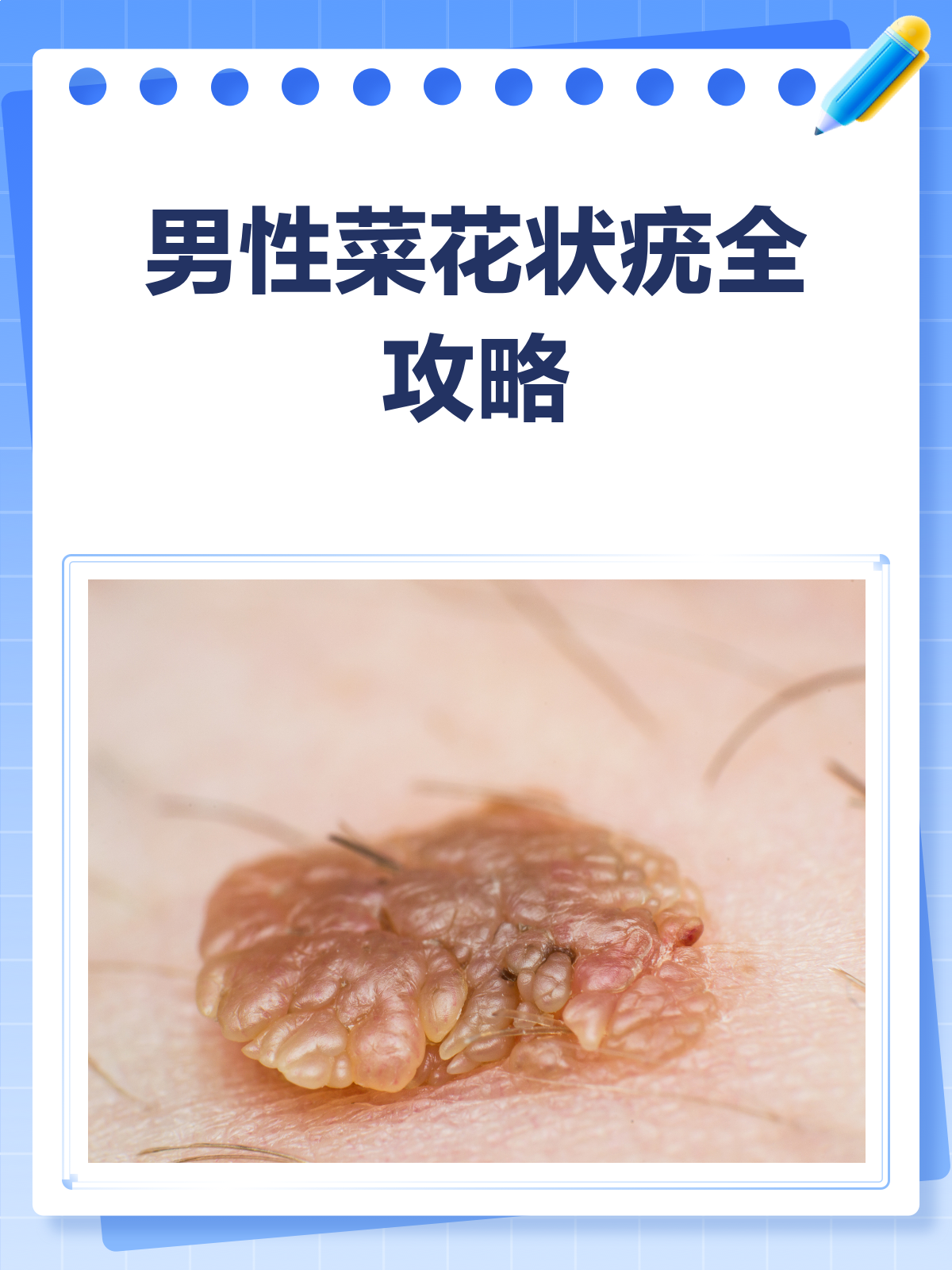 男性菜花状疣怎么办？治疗方法全攻略！