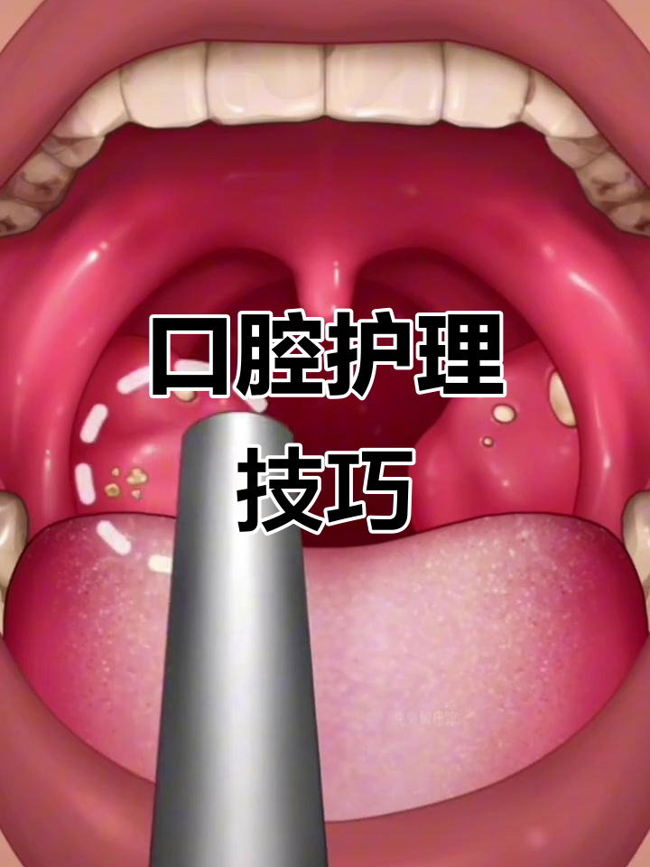 口腔护理全攻略:如何应对菜花嘴、扁桃体结石等常见问题