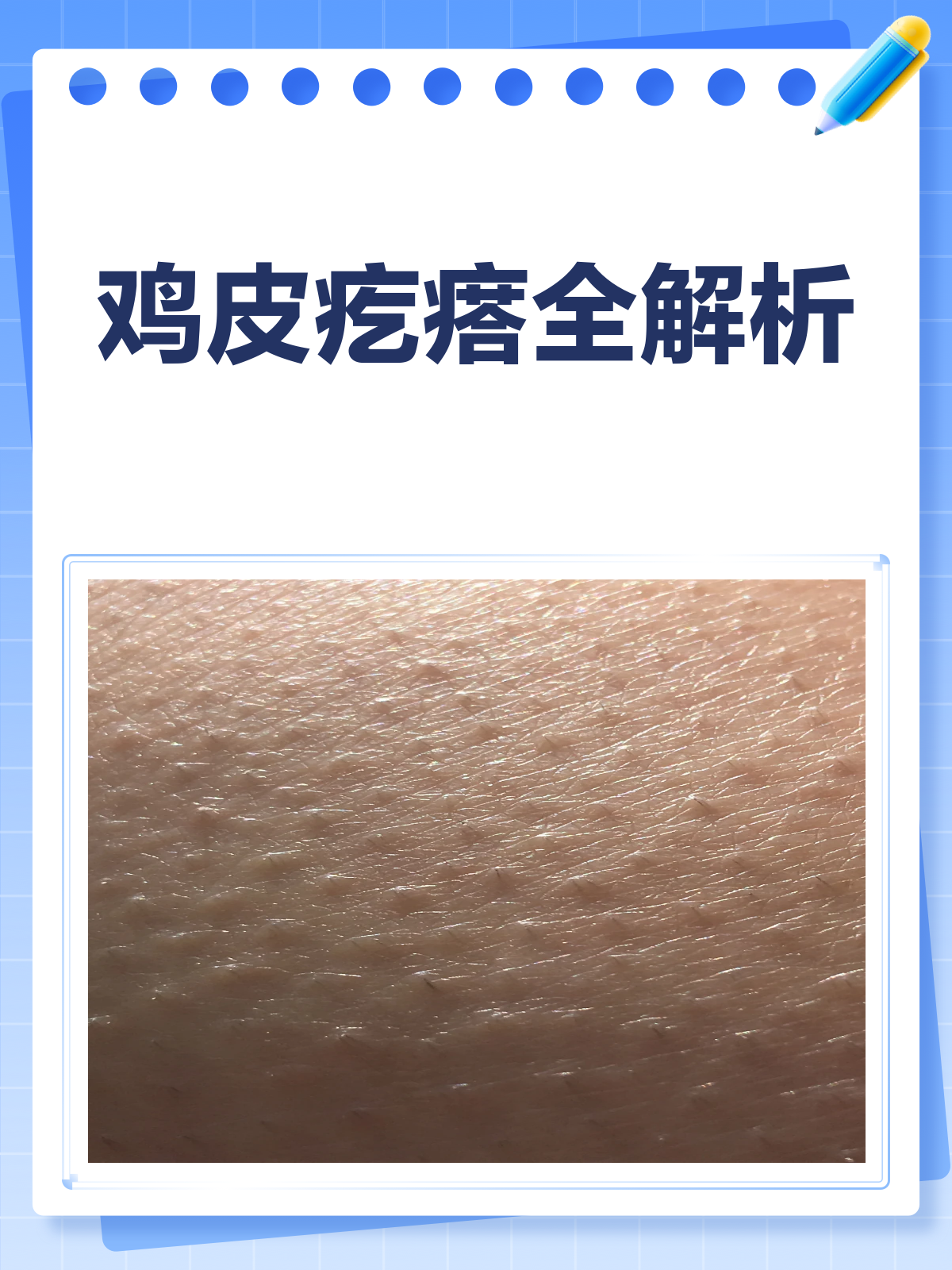 鸡皮疙瘩是咋回事？一文给你讲清楚！