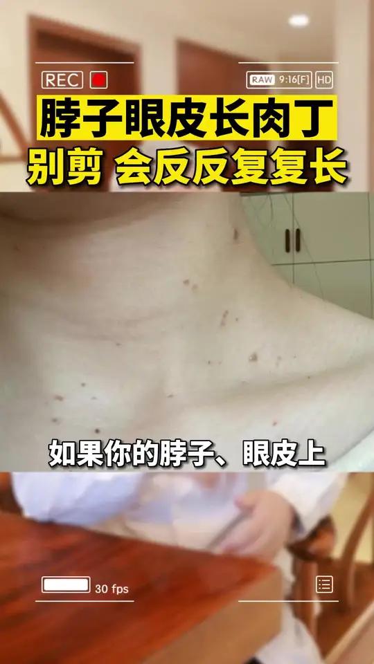 如果你的眼皮、脖子上长了小肉丝,孙叔来教你处理