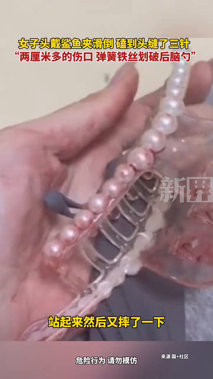 女子头戴鲨鱼夹滑倒 磕到头缝了三针