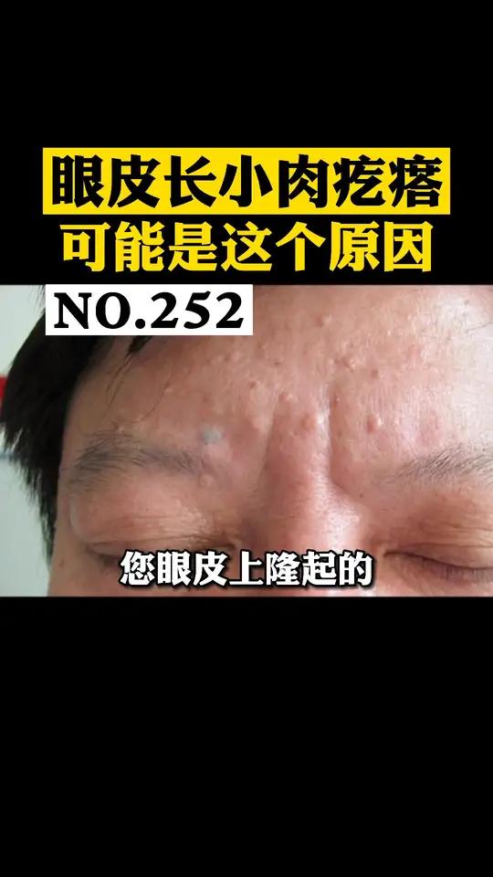 眼皮,额头上出现这些隆起的,接近肤色的小肉疙瘩,可能是