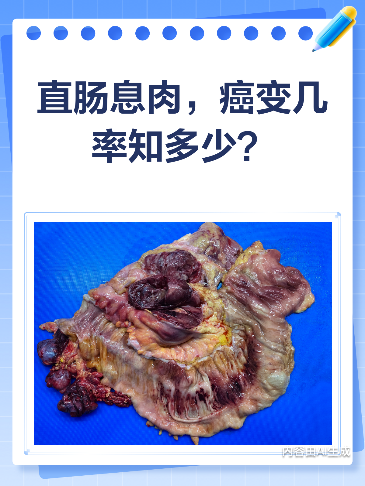 直肠息肉会癌变吗?一文给你讲明白!