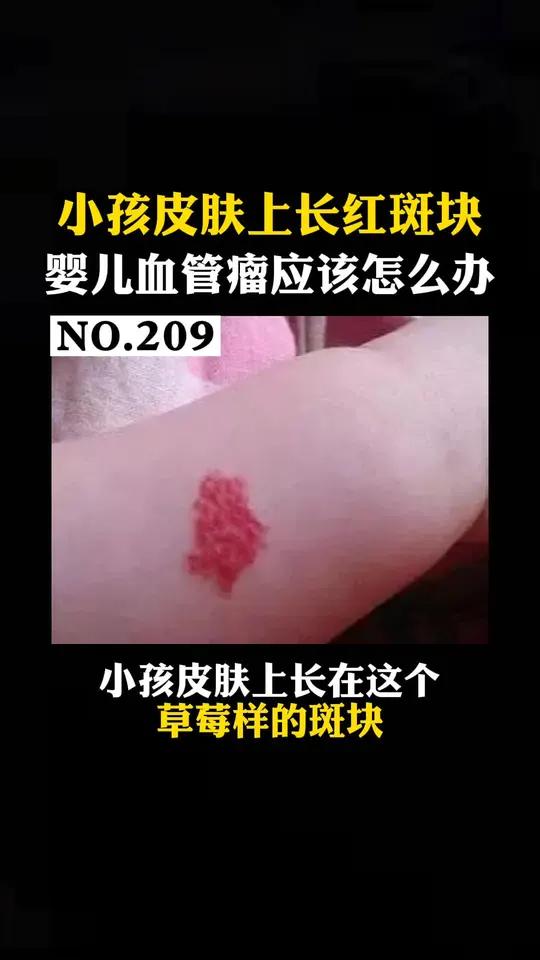 小孩皮肤上长红色的凸起斑块,这个是婴儿血管瘤,家长们要引起重视,不要自己在家处理