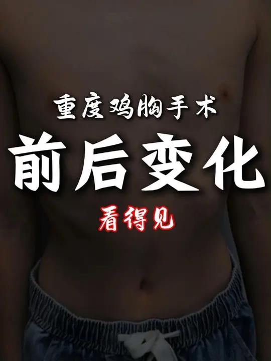重度鸡胸,术后,胸廓 有什么变化