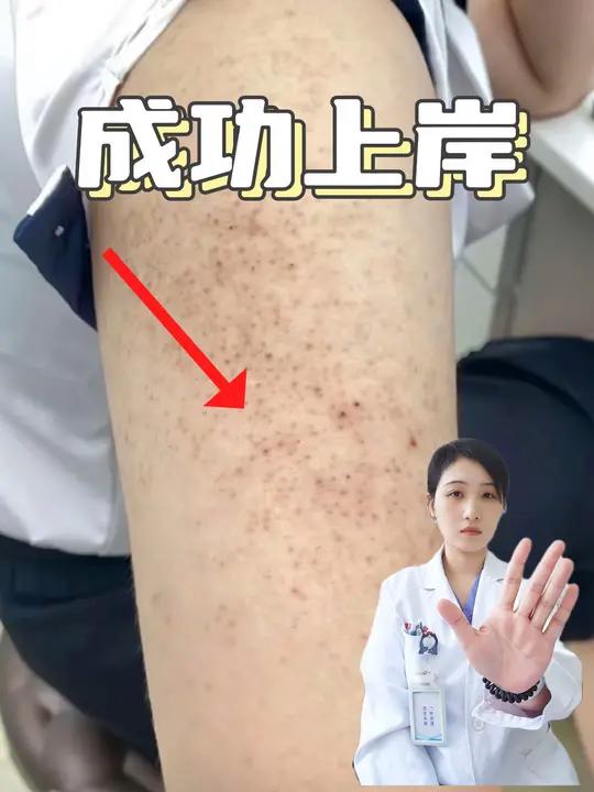 淡化鸡皮肤,教你两个小妙招~