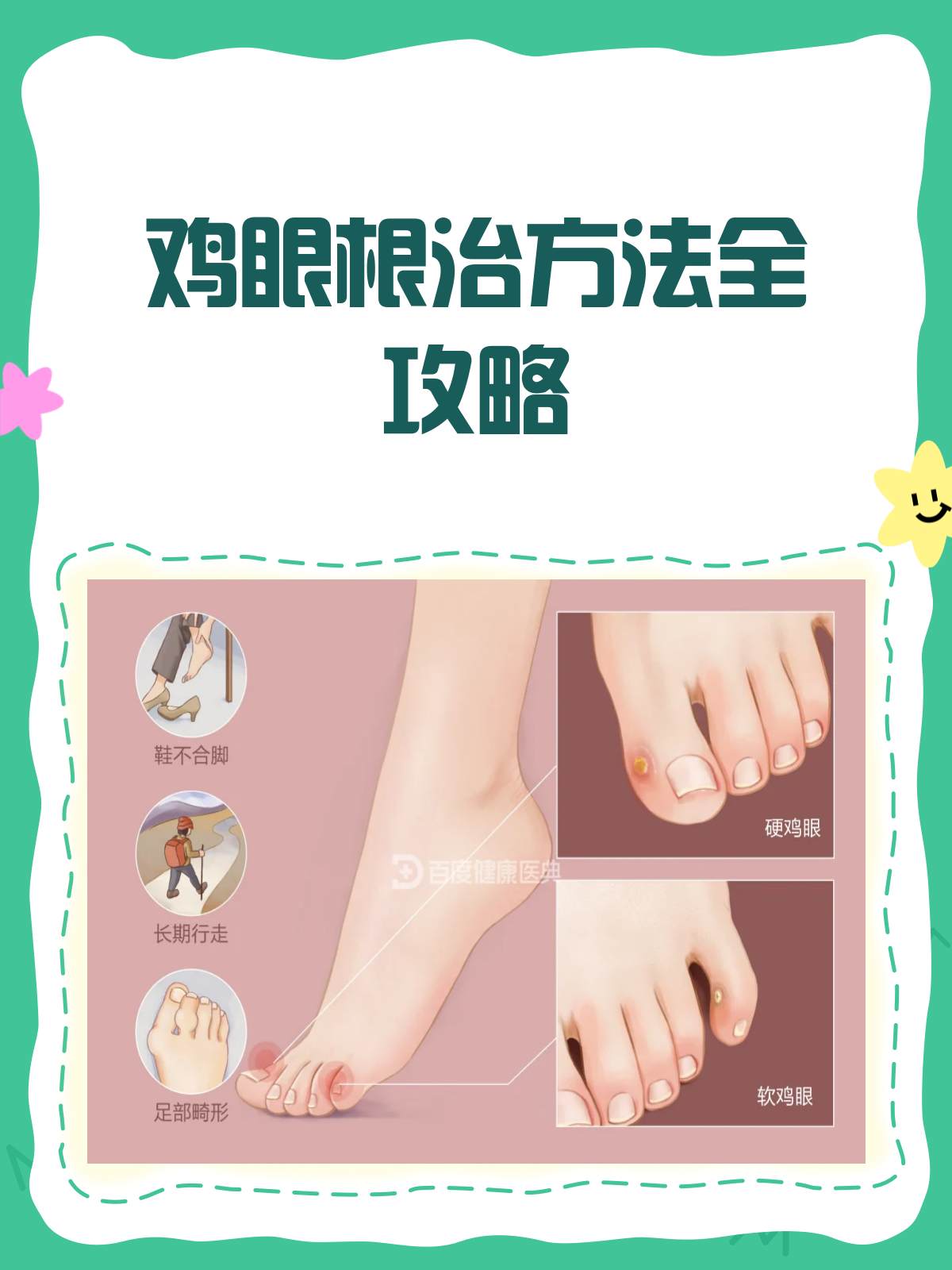 鸡眼烦恼别再愁!这样治疗能除根