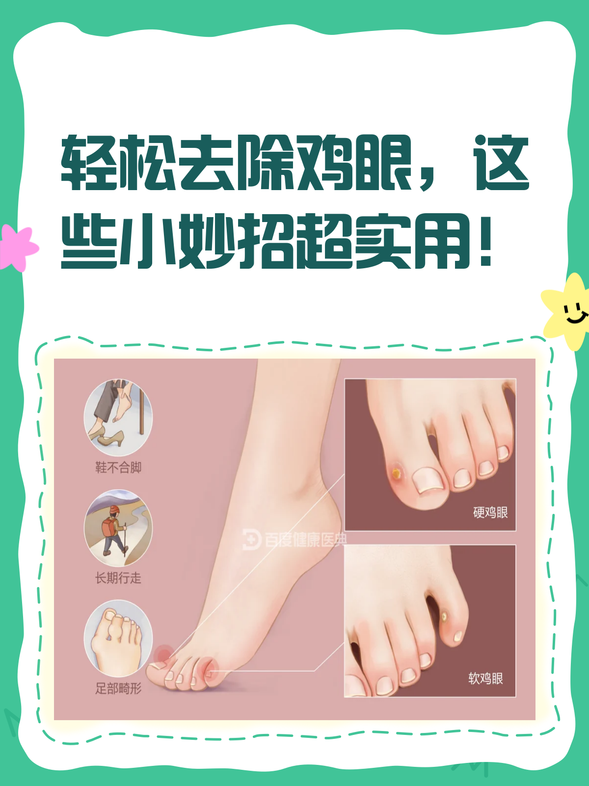 告别疼痛!去除鸡眼的小妙招来啦!