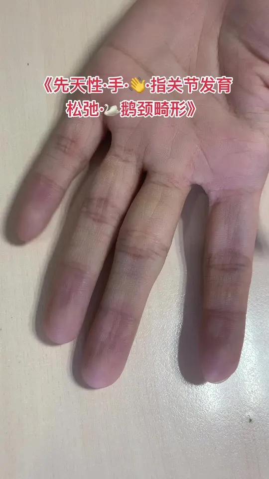 你的手指可以柔韧弯曲到这种情况吗手外伤手外伤肌腱损伤伸肌腱损伤掌板损伤肌腱断裂肌腱修复肌腱