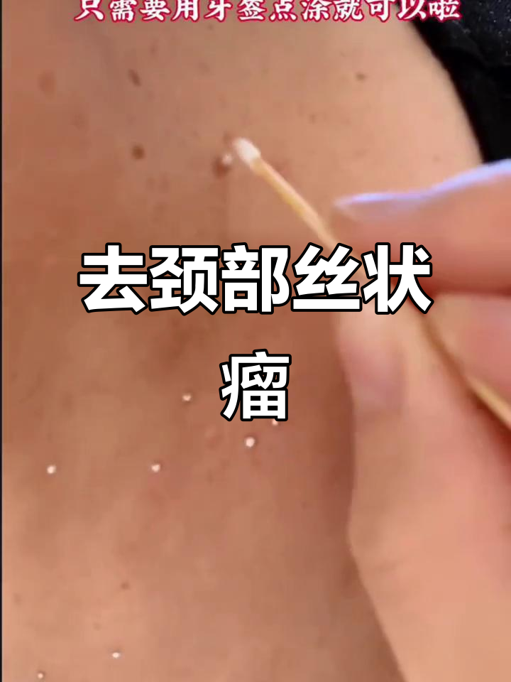 脖子腋下小肉粒轻松去除，温和去质膏效果显著