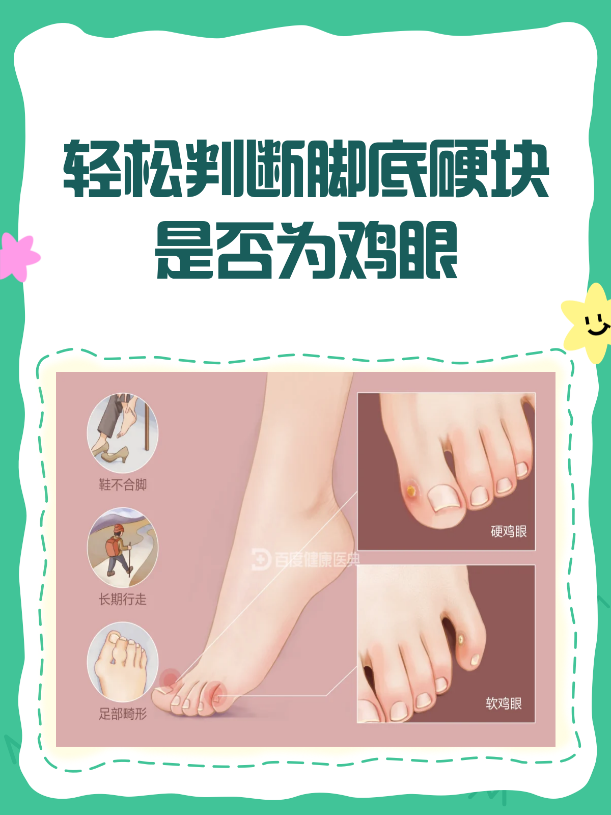 脚底长硬块?教你5招判断是不是鸡眼!