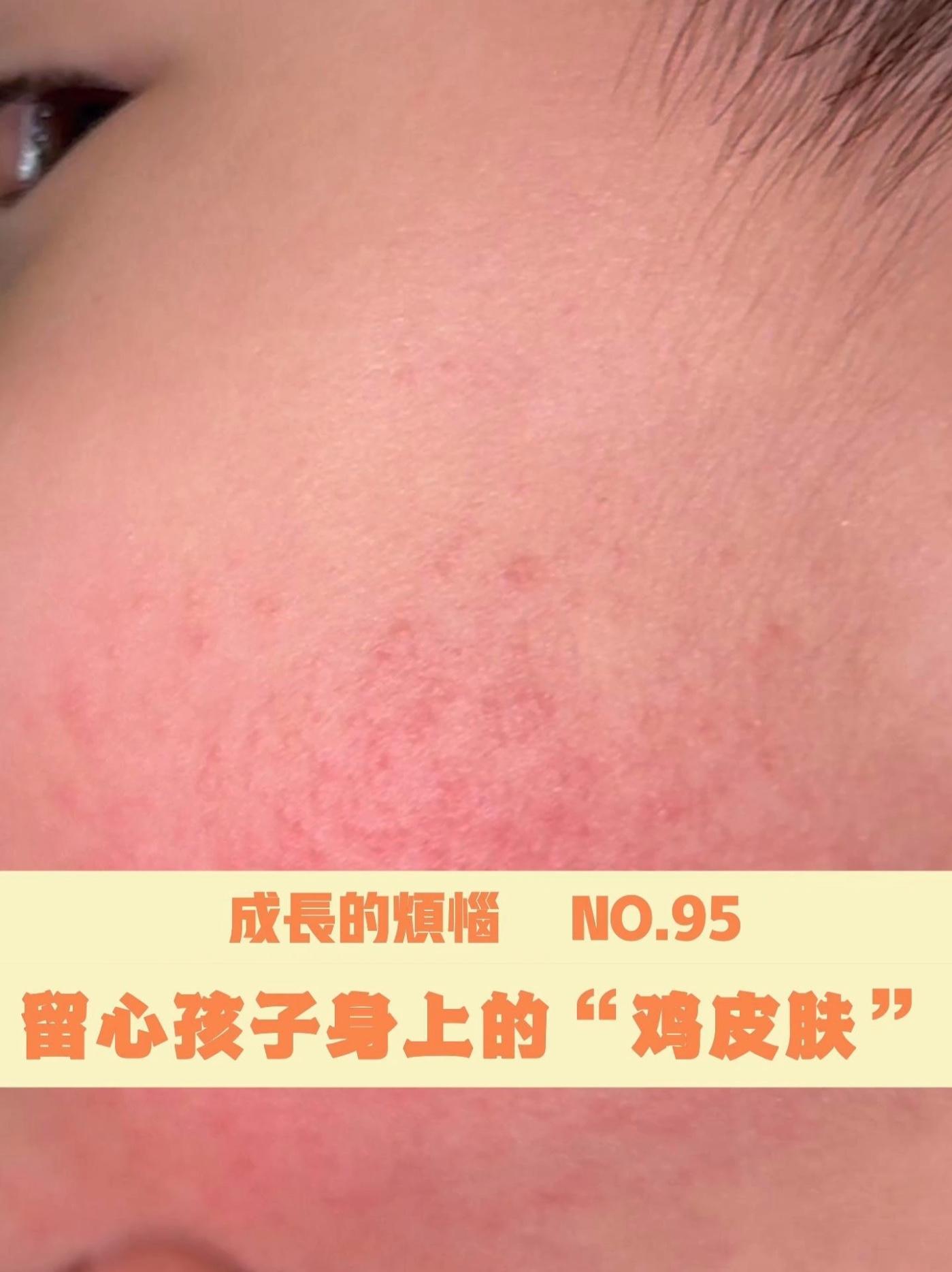 成长的烦恼：留心孩子身上的“鸡皮肤” #医学科普